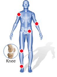 Knee - Patient Testimonials